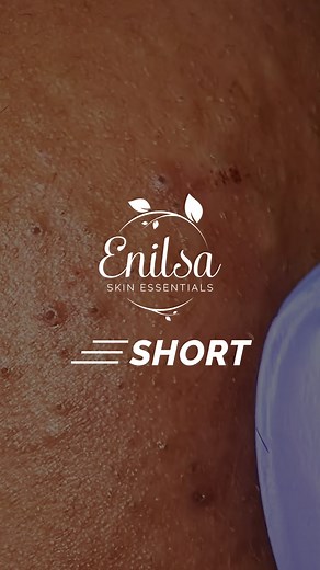 Enilsa Brown on Instagram: "Hello dearest friends! 😇 We just found, edited and published a recording of Netty's 9th treatment with us at the clinic. This one was recorded before the dermaplaning session. It's short but there are a lot of blackhead extractions. Head to Youtube for the full video! I hope you like it! 😘 Full video 👉 https://www.youtube.com/watch?v=6qhAFOUuzlI 🎼 Artlist.io - Family Kush - Cool Cats #extractions #blackhead #skincare #blackheadremoval #acne"