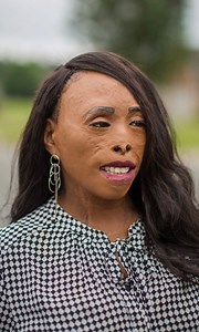 3.8M views · 1.5K reactions | A burns survivor who suffered third degree burns at just two years old is now an award-winning fashion designer ✨ | Shake My Beauty | Facebook