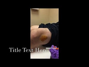 Knee Aspiration and Cortisone Injection for the Treatment of Knee Arthritis