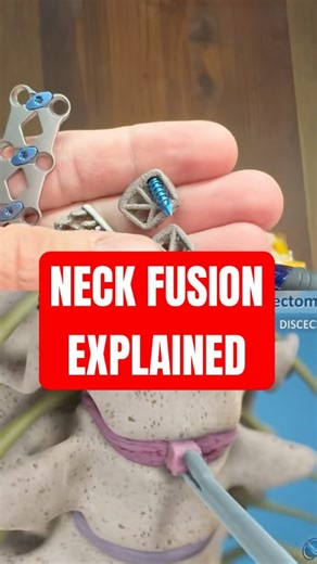 Fact 11- ACDF cages and plates