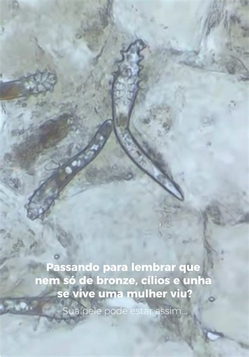 Você sabia que o ácaro Demodex encontra um ambiente favorável em peles com excesso de oleosidade e acúmulo de impurezas, resíduos e células mortas? A limpeza de pele não é vaidade, é prevenção, equilíbrio e cuidado real com a saúde da pele. #limpezadepele #esteticistaecosmetologa #esteticafacial #esteticaecosmetica