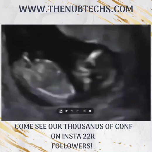 Gender Reveal at 12 Week Scan | The Nub Techs Method