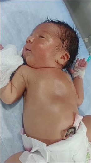 Abdominal obstruction baby in NICU #GutHealth#BowelBlockage#StomachPain#MedicalAwareness#cute.