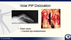 The PIP Joint: Soul of the The Hand - Fractures and Dislocations
