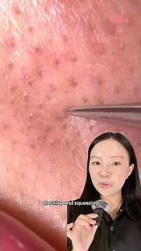 How to treat blackheads / sebaceous filaments 😶‍🌫️