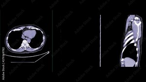 CT Chest with Contrast or CTA pulmonary artery axial NC ,Coronal and sagittal view for diagnosis pulmonary embolism and lung disease.