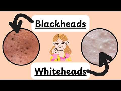 Blackheads and Whiteheads | Acne