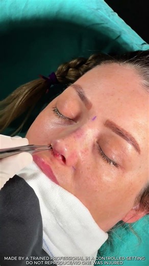 Doctor removes nasal inserts after surgery