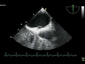 PFO : PATENT FORAMEN OVALE TOE / Foramen oval permeable ETO echocardiography