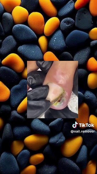 Effective Toenail Removal Techniques for Ingrown Nails