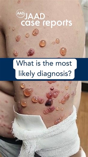 JAAD Journals | What is the most likely diagnosis? Tell us your answer in the comments and visit the link in the bio to find out. A. Bullous pemphigoid... | Instagram