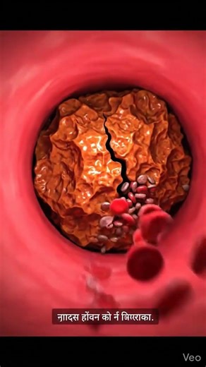How Blocked Arteries Cause High Blood Pressure | Medical Animation