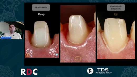 RDC - Vertical Preparation with Dr Mostafa Mohamed Taha | Mahmoud Elnagar