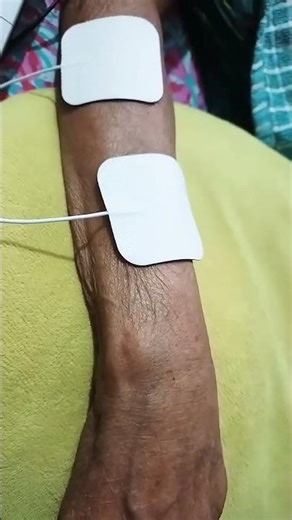 "The Electric Spark: TENS EMS Protocol for Post-Stroke Muscle Rehab #NeuroScience"