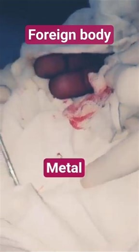 You Won't believe what was inside! Surgical removal-foreign body#surgery#foreignbodyremoval #medical