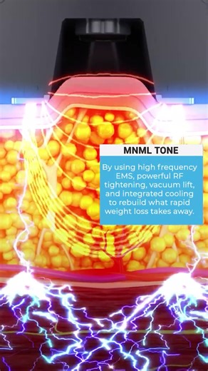 Why Your Body Looks “Deflated” After Semaglutide