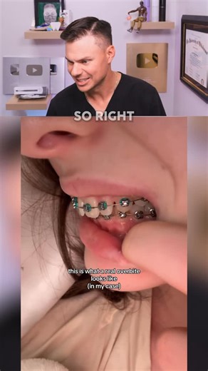 TheBentist on Instagram: "This Is What A Real OVERBITE Looks Like! 😮🦷 #teeth #dentist #braces"