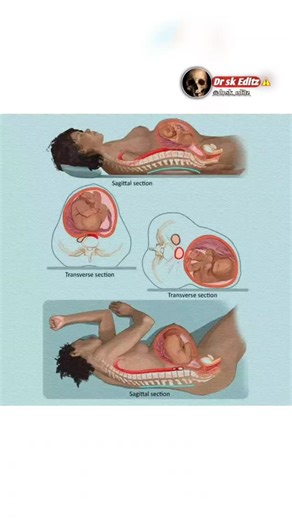 Doctor sk 👩🏻‍⚕️ on Instagram: "BABY POSITION DURING PREGNANCY💕 Simple guide to how your little one sits inside the womb. 📌CEPHALIC (HEAD-DOWN) position for birth. Best and safest 📌BREECH (FEET/BUTT DOWN) Common early; many babies flip by week 36. 📌TRANSVERSE (SIDEWAYS) - Baby is lying across the belly, not ready for labor. 📌OBLIQUE (DIAGONAL) - Baby is slanted; usually changes position later. 📌POSTERIOR (HEAD-DOWN, FACE-UP) Can cause back labor but still normal. 📌BABY MOVES OFTEN - Posi