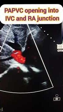 PAPVC Opening into IVC and RA junction#Scimitar vein opening into RA