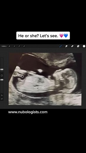Gender Prediction Ultrasound: Boy or Girl - Nubologists
