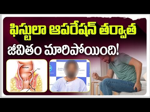 From Pain to Recovery: Fistula Surgery Before and After | Patient Testimonials | Dr Sridhar Reddy