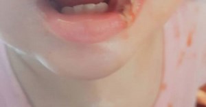 Mum issues phone charger warning after toddler suffers electrical burn on mouth - Netmums