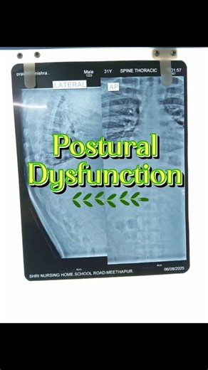 🚨Struggling with postural dysfunction, neck pain, or back pain? 💆‍♀️ #procare #shorts #healing