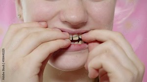 Teenage girl putting dental retainer on teeth closeup