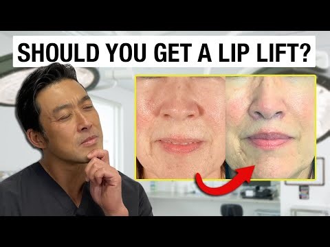 Should You Get A Lip Lift? (+ Before and After Results!)