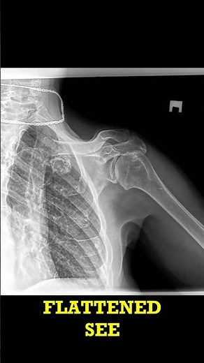 Shoulder X-Ray Spot the Arthritis! (Short)