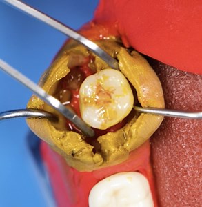 296K views · 534 reactions | Inside the Surgery Room: Tooth Extraction Explained | 3-Minute Hacks | Facebook