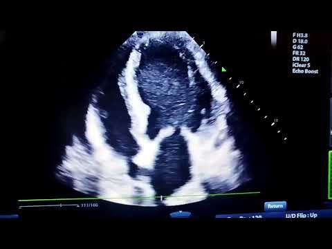 Ischemic Dilated Cardiomyopathy ، Encysted pericardial Effusion compressing Right Atrium