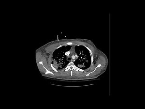 Partial anomalous pulmonary venous return (PAPVR)