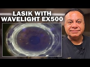 LASIK Surgery with the WaveLight Excimer EX500 Laser and Flap Creation