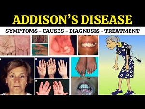 Addison's Disease Explained: Symptoms, Causes, Diagnosis & Treatment -Don't Miss These Warning Signs