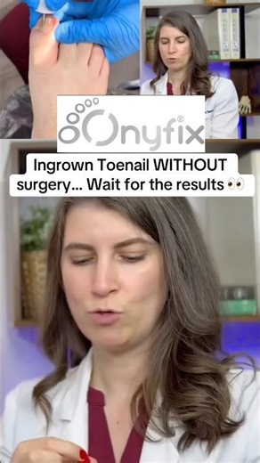 Ingrown Toenails WITHOUT Surgery! Check out the FULL video on ‪@StepSistersDPM‬