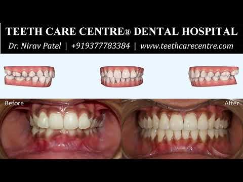 Invisalign Before and After - Deep Bite Correction and Arch Expansion