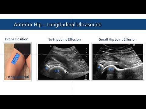 Ultrasound in Hip Pain and Arthrocentesis