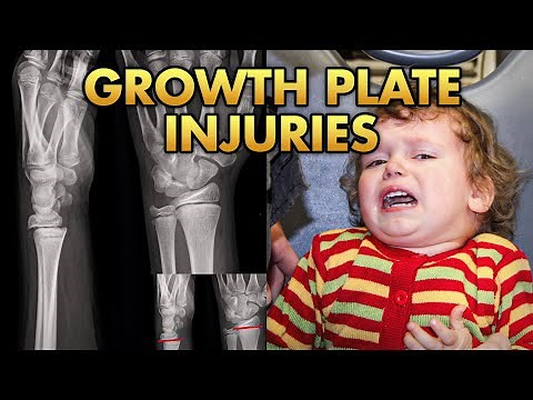 Growth Plate Fractures Explained with X-Ray Examples