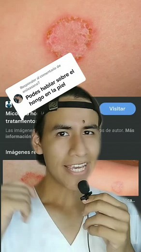 Micosis en la Piel: Causas, Síntomas y Tratamientos