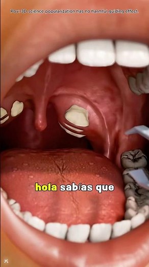How tonsil stones are form? Medical Animation 3D#tonsils #tonsillitis #tonsilstonesremoval