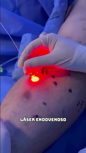 Endovenous laser in action - Treatment of varicose veins with venous insufficiency