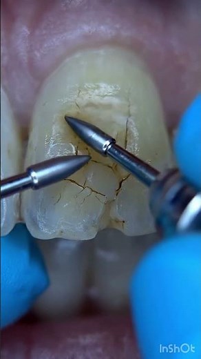 Cuidado com o dente.