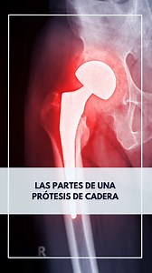 3.1K views · 62 reactions | ¿Cómo está formada una prótesis de...