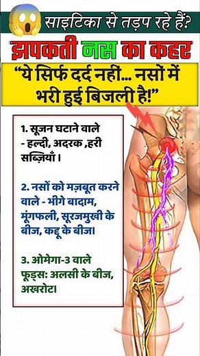 Sciatica Nas Ka Dard 😱😭🔥 #viralvideo #viralshorts #sciaticatreatmentinhindi #physiodrdeepaksoni