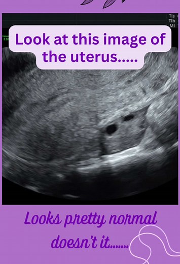 Understanding Endometriosis Through Ultrasound Imaging