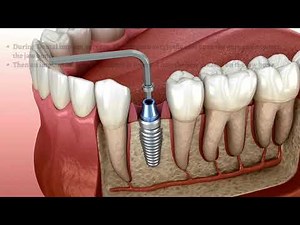The Step-by-Step Process of Dental Implant Placement