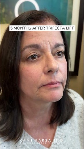 5 Months After Amazing Eye Bag Transformation