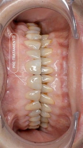 CARILLAS dentales: ¿cómo funcionan? Así se transforma una sonrisa con #carillas #carillasdentales
