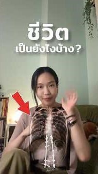 รีวิวผ่าตัดกระดูกสันหลังคดมา (เกือบ) 4 ปี ชีวิตเป็นยังไงบ้าง ? 🩻 #scoliosis #shorts